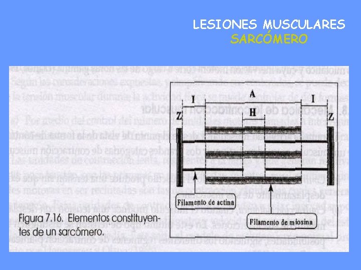 LESIONES MUSCULARES SARCÓMERO 
