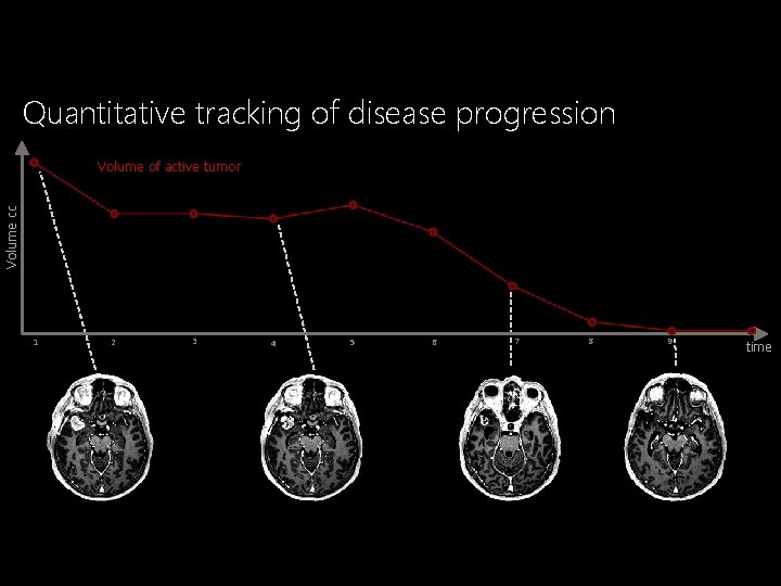Quantitative tracking of disease progression Volume cc Volume of active tumor 1 2 3