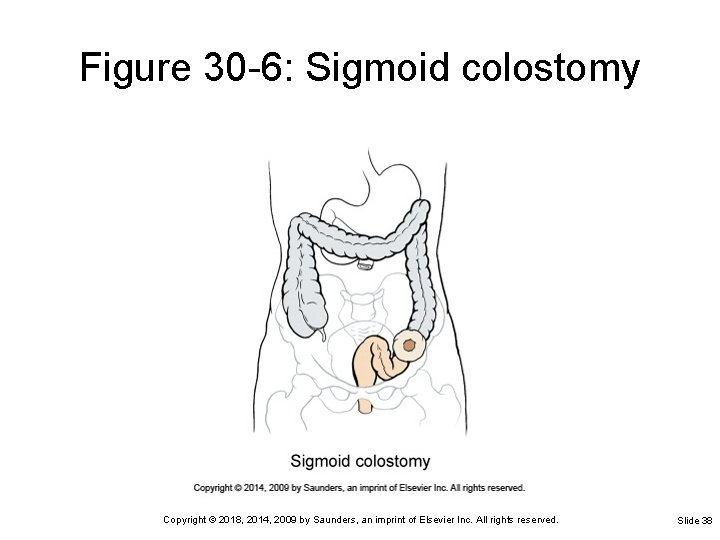 Figure 30 -6: Sigmoid colostomy Copyright © 2018, 2014, 2009 by Saunders, an imprint