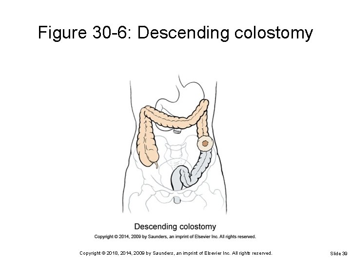 Figure 30 -6: Descending colostomy Copyright © 2018, 2014, 2009 by Saunders, an imprint