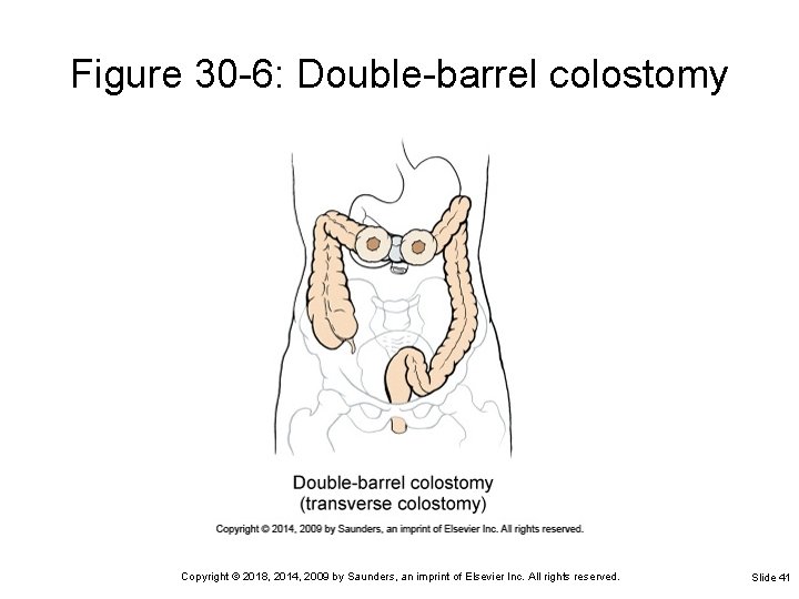 Figure 30 -6: Double-barrel colostomy Copyright © 2018, 2014, 2009 by Saunders, an imprint