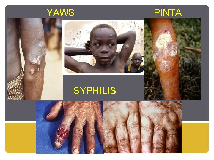 YAWS SYPHILIS PINTA 