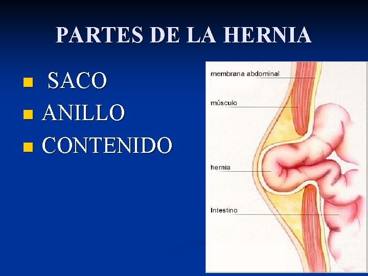 PARTES DE LA HERNIA n n n SACO ANILLO CONTENIDO 