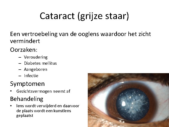 Cataract (grijze staar) Een vertroebeling van de ooglens waardoor het zicht vermindert Oorzaken: –