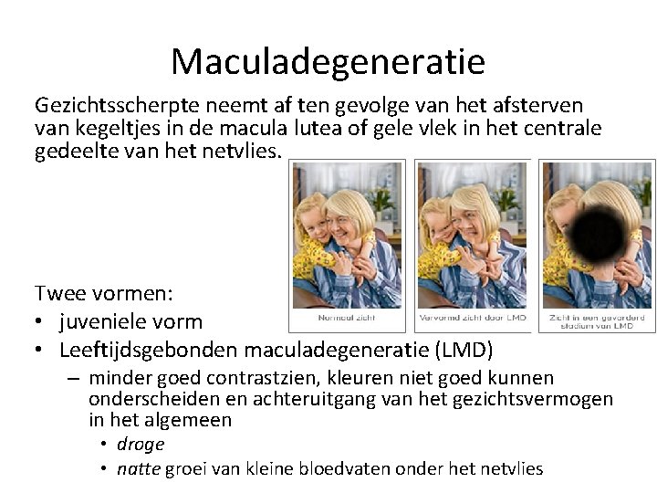 Maculadegeneratie Gezichtsscherpte neemt af ten gevolge van het afsterven van kegeltjes in de macula