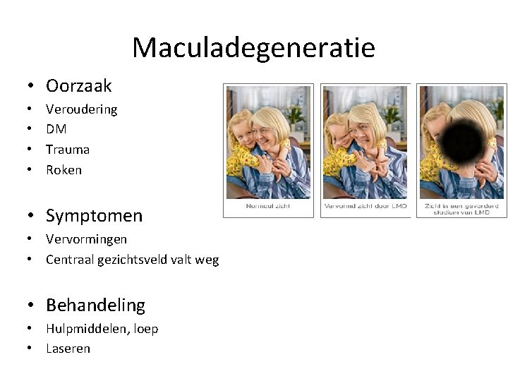 Maculadegeneratie • Oorzaak • • Veroudering DM Trauma Roken • Symptomen • Vervormingen •