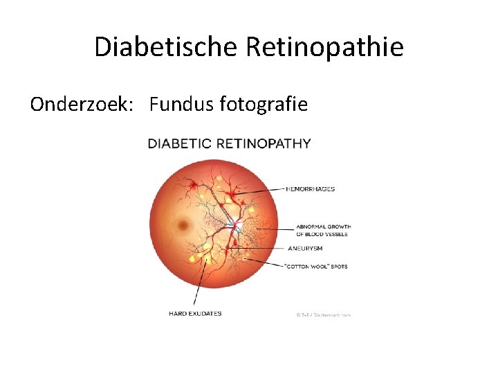 Diabetische Retinopathie Onderzoek: Fundus fotografie 