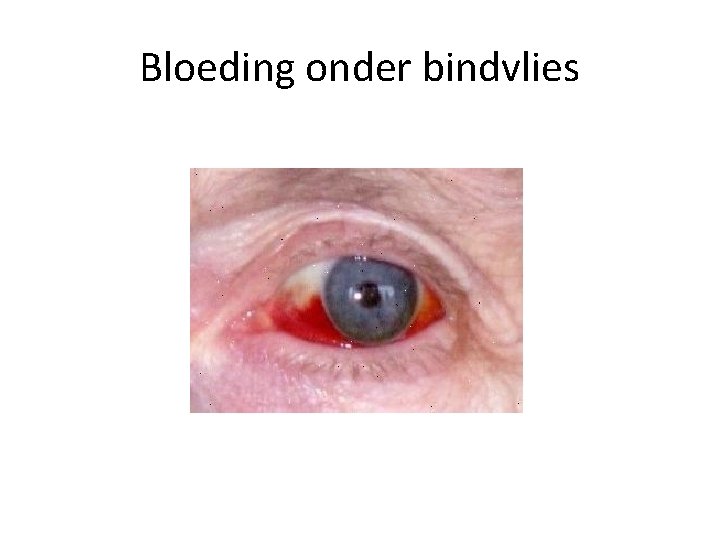 Bloeding onder bindvlies 