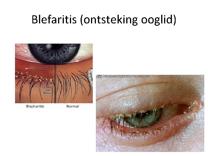 Blefaritis (ontsteking ooglid) 