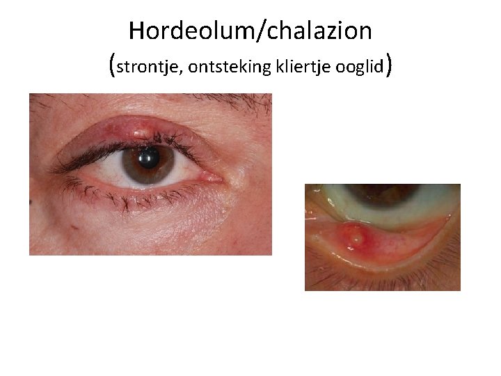 Hordeolum/chalazion (strontje, ontsteking kliertje ooglid) 