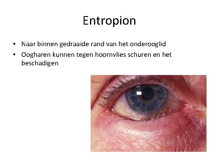 Entropion • Naar binnen gedraaide rand van het onderooglid • Oogharen kunnen tegen hoornvlies