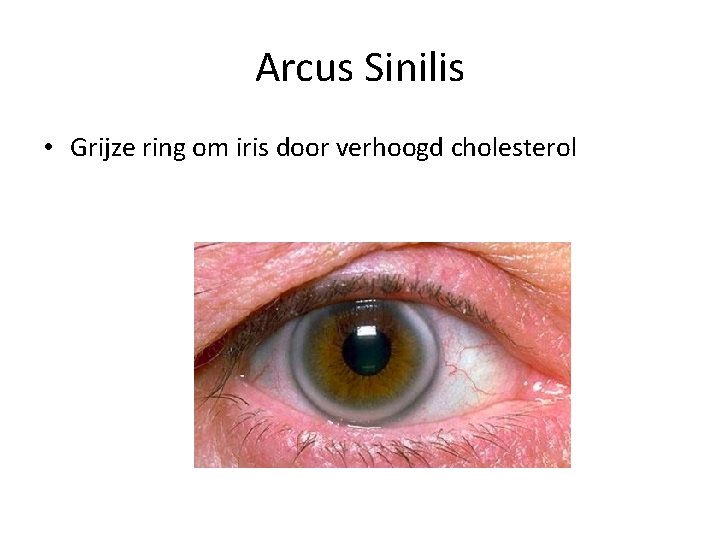 Arcus Sinilis • Grijze ring om iris door verhoogd cholesterol 