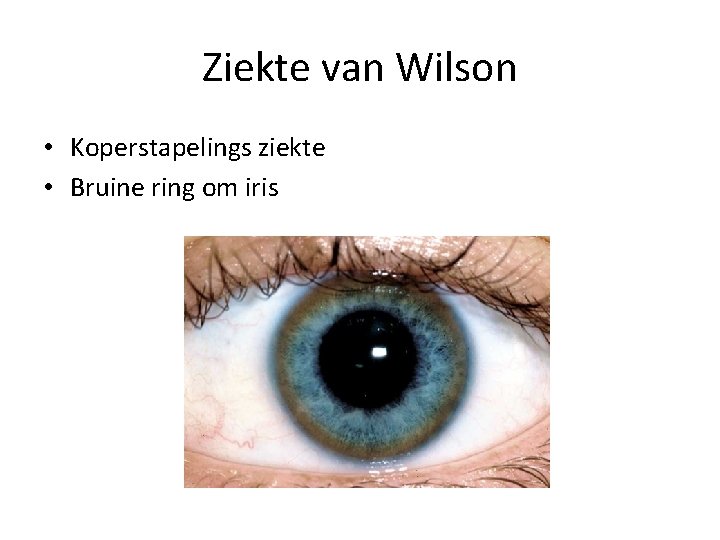 Ziekte van Wilson • Koperstapelings ziekte • Bruine ring om iris 