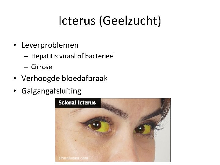 Icterus (Geelzucht) • Leverproblemen – Hepatitis viraal of bacterieel – Cirrose • Verhoogde bloedafbraak