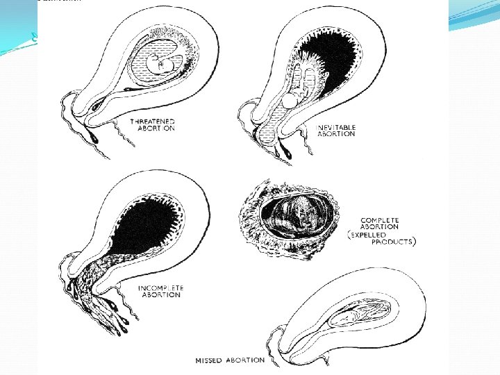  Avortul – forme clinice 