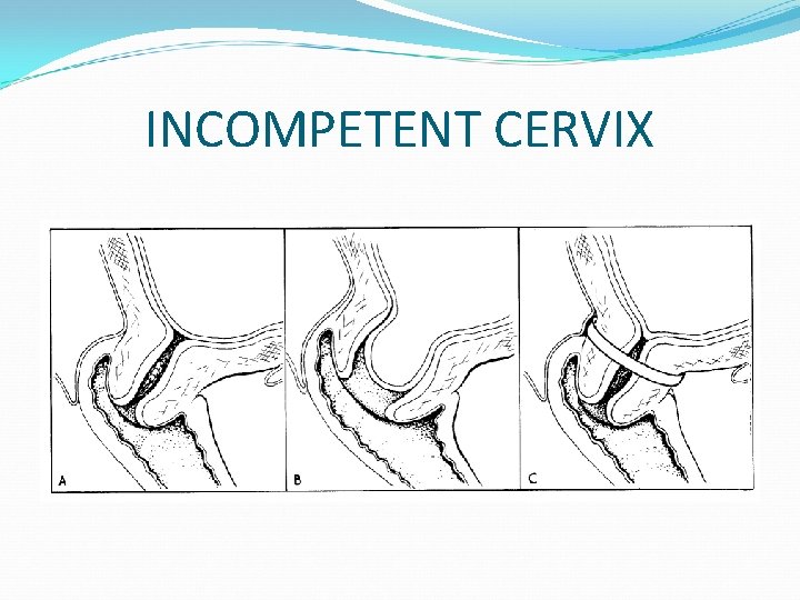 INCOMPETENT CERVIX 