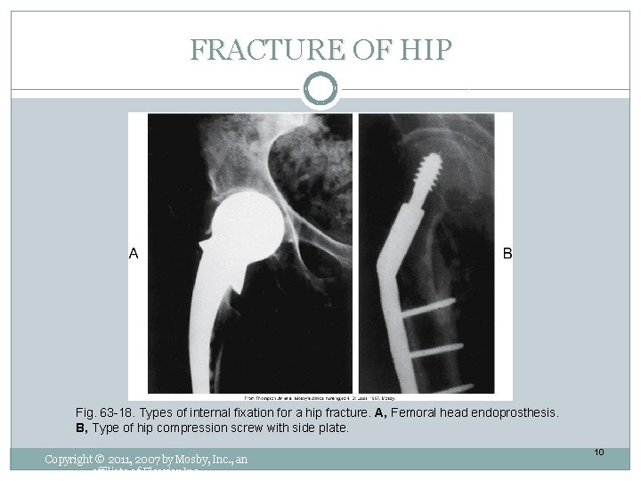 FRACTURE OF HIP Fig. 63 -18. Types of internal fixation for a hip fracture.