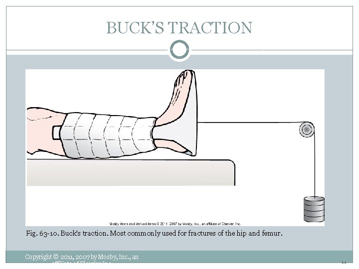 BUCK’S TRACTION Fig. 63 -10. Buck’s traction. Most commonly used for fractures of the