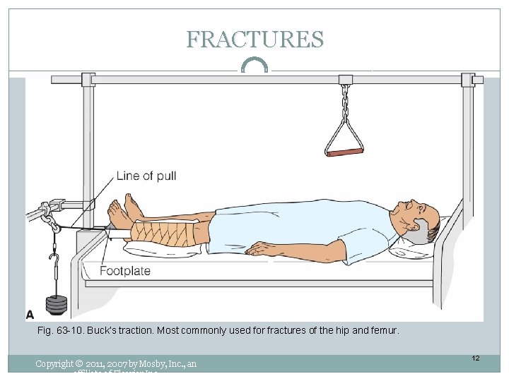 FRACTURES Fig. 63 -10. Buck’s traction. Most commonly used for fractures of the hip