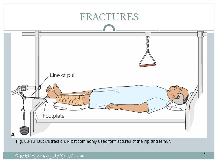 FRACTURES Fig. 63 -10. Buck’s traction. Most commonly used for fractures of the hip FRACTURES Fig. 63 -10. Buck’s traction. Most commonly used for fractures of the hip