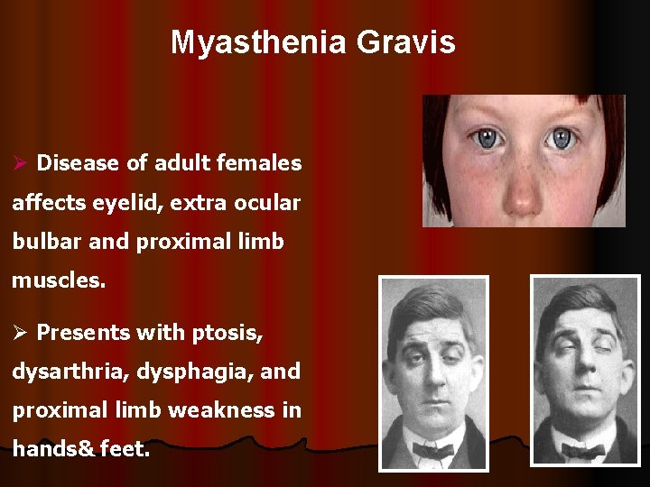 Myasthenia Gravis Ø Disease of adult females affects eyelid, extra ocular bulbar and proximal