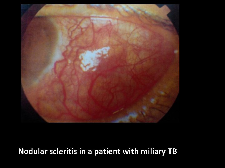Nodular scleritis in a patient with miliary TB 