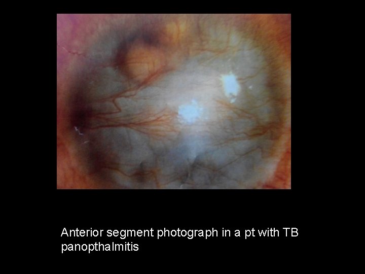 Anterior segment photograph in a pt with TB panopthalmitis 