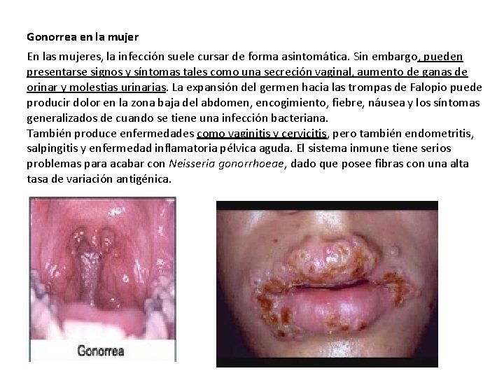 Gonorrea en la mujer En las mujeres, la infección suele cursar de forma asintomática.