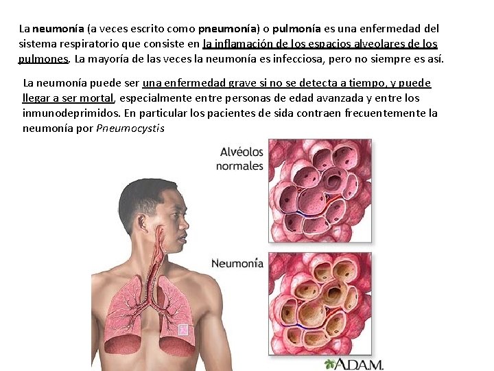 La neumonía (a veces escrito como pneumonía) o pulmonía es una enfermedad del sistema