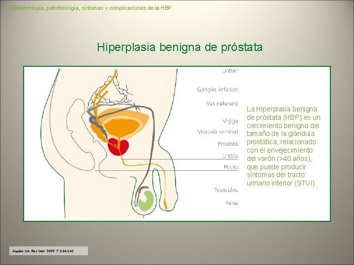 Epidemiología, patofisiología, síntomas y complicaciones de la HBP Hiperplasia benigna de próstata La Hiperplasia