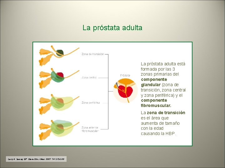 La próstata adulta está formada por las 3 zonas primarias del componente glandular (zona