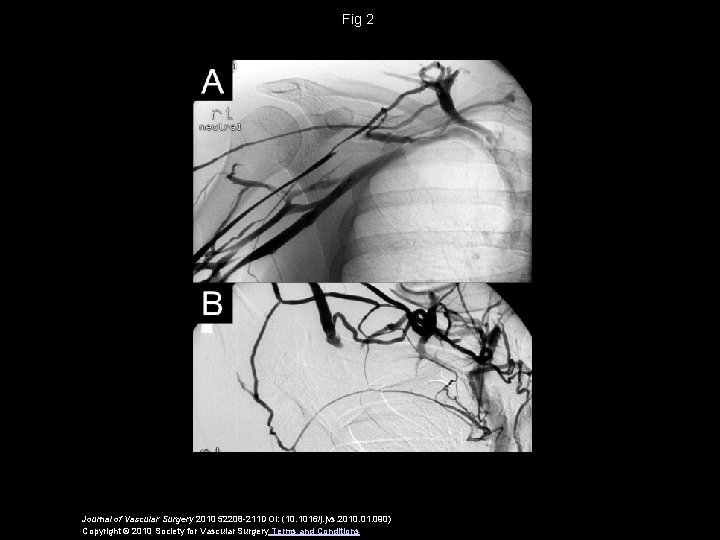 Fig 2 Journal of Vascular Surgery 2010 52208 -211 DOI: (10. 1016/j. jvs. 2010.