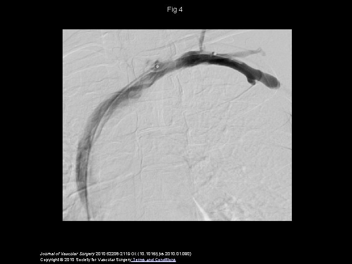 Fig 4 Journal of Vascular Surgery 2010 52208 -211 DOI: (10. 1016/j. jvs. 2010.