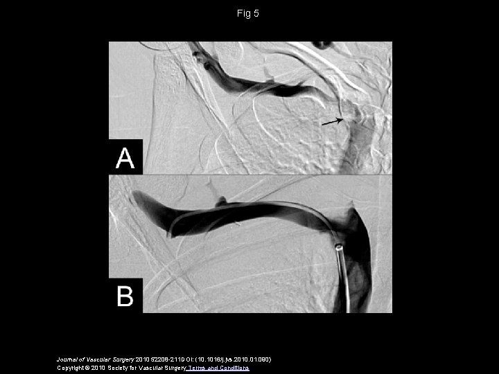 Fig 5 Journal of Vascular Surgery 2010 52208 -211 DOI: (10. 1016/j. jvs. 2010.