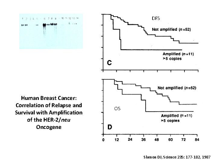 DFS Human Breast Cancer: Correlation of Relapse and Survival with Amplification of the HER-2/neu