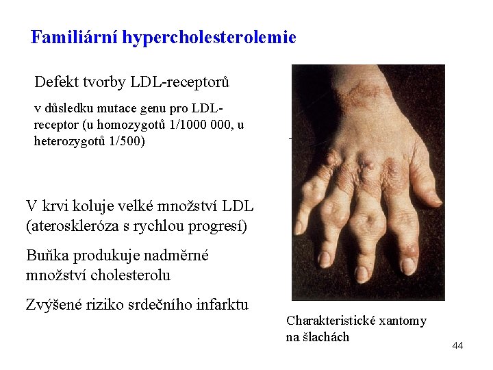 Familiární hypercholesterolemie Defekt tvorby LDL-receptorů v důsledku mutace genu pro LDLreceptor (u homozygotů 1/1000