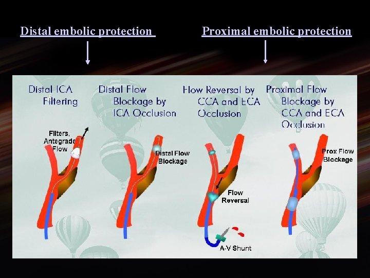 Distal embolic protection Proximal embolic protection 