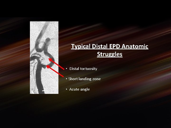 Typical Distal EPD Anatomic Struggles • Distal tortuosity • Short landing zone • Acute