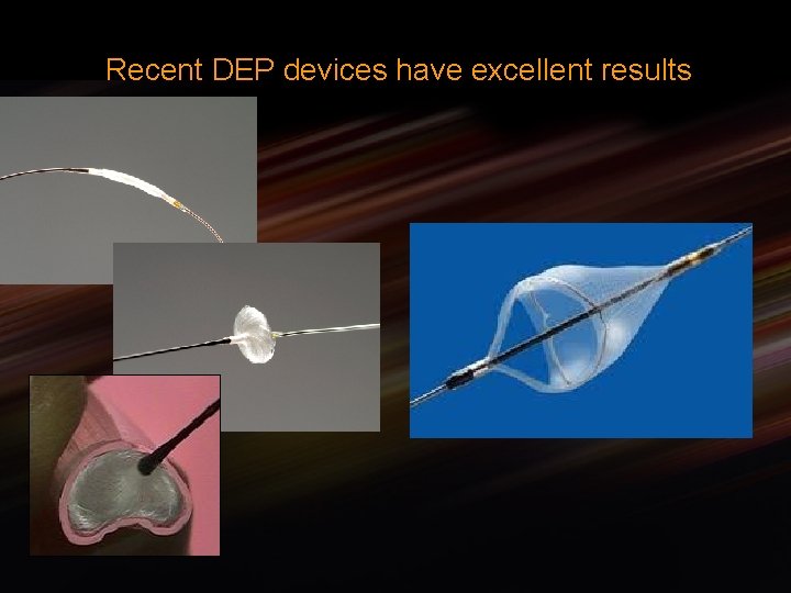 Recent DEP devices have excellent results 