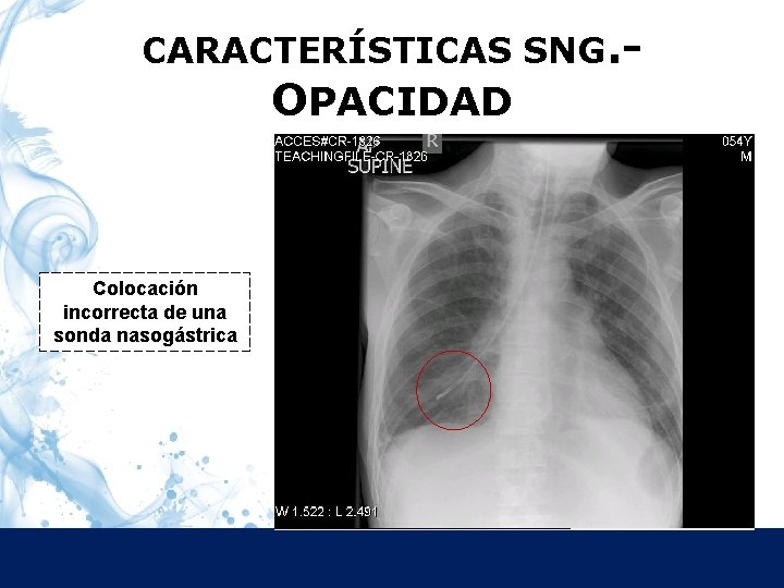 CARACTERÍSTICAS SNG. Características OPACIDAD Colocación incorrecta de una sonda nasogástrica 