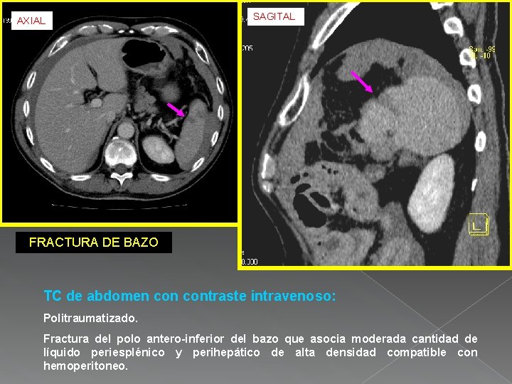 AXIAL SAGITAL FRACTURA DE BAZO TC de abdomen contraste intravenoso: Politraumatizado. Fractura del polo