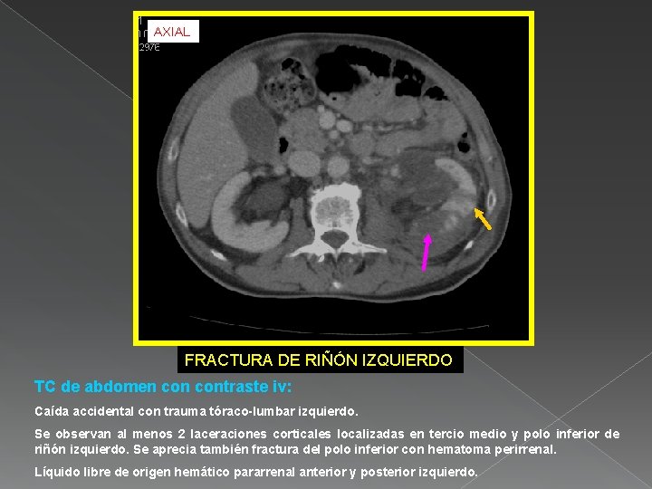 AXIAL FRACTURA DE RIÑÓN IZQUIERDO TC de abdomen contraste iv: Caída accidental con trauma