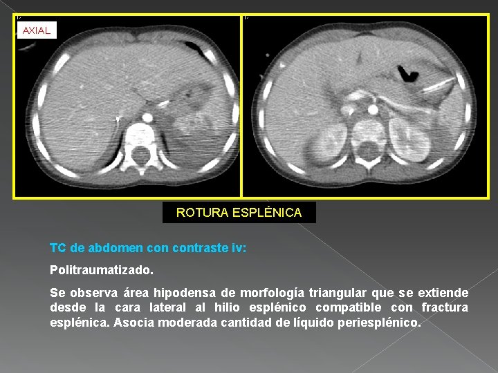 AXIAL ROTURA ESPLÉNICA TC de abdomen contraste iv: Politraumatizado. Se observa área hipodensa de