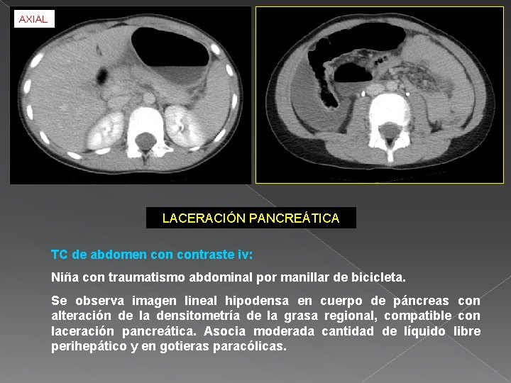 AXIAL LACERACIÓN PANCREÁTICA TC de abdomen contraste iv: Niña con traumatismo abdominal por manillar