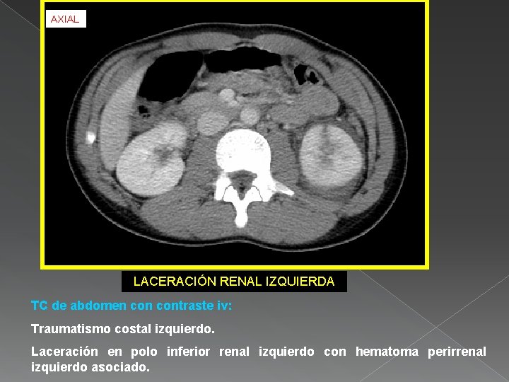 AXIAL LACERACIÓN RENAL IZQUIERDA TC de abdomen contraste iv: Traumatismo costal izquierdo. Laceración en
