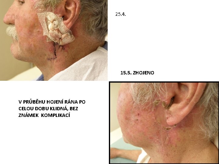 25. 4. 15. 5. ZHOJENO V PRŮBĚHU HOJENÍ RÁNA PO CELOU DOBU KLIDNÁ, BEZ