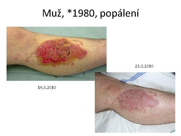 Muž, *1980, popálení 23. 3. 2010 16. 3. 2010 