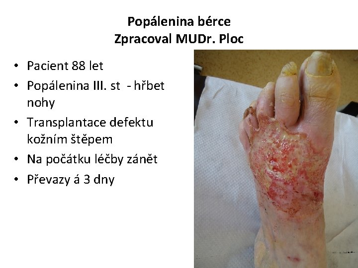 Popálenina bérce Zpracoval MUDr. Ploc • Pacient 88 let • Popálenina III. st -