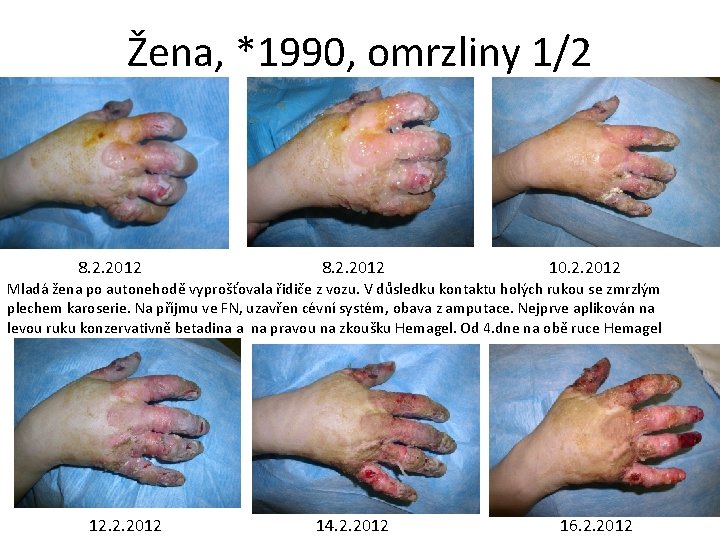 Žena, *1990, omrzliny 1/2 8. 2. 2012 10. 2. 2012 Mladá žena po autonehodě