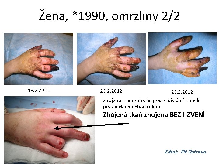 Žena, *1990, omrzliny 2/2 18. 2. 2012 20. 2. 2012 23. 2. 2012 Zhojeno